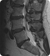 Lumbar Spondylolisthesis, Merriwa, Western Australia