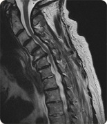 Lumbar Spondylolisthesis, Merriwa, Western Australia